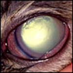 Glaucoma Eye