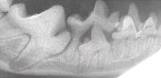 Impacted Tooth